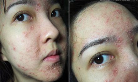 Kesalahan Memakai Skincare Yang Bisa Merusak Kulit