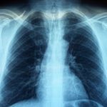 Rontgen: Prosedur Pemeriksaan Dan Manfaatnya Diagnosis Medis
