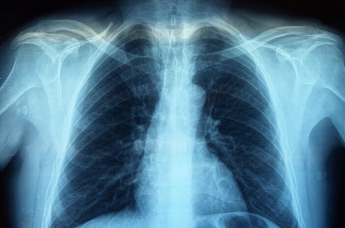Rontgen: Prosedur Pemeriksaan Dan Manfaatnya Diagnosis Medis